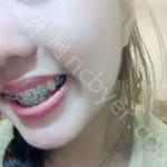 武汉爱齿尔口腔医院徐安斌牙齿矫正案例分享
