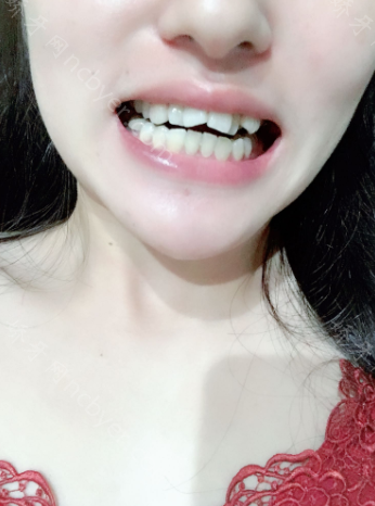 厦门思迈尔口腔陈经纬牙齿矫正案例展示