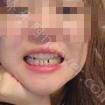 武汉牙达人口腔医院陈思牙齿矫正案例分享