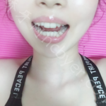 武汉牙达人口腔医院李旋牙齿矫正案例分享