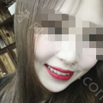 武汉牙达人口腔医院李旋牙齿矫正案例分享