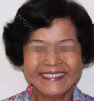 长沙开福好大夫口腔门诊部谭建武牙齿种植前后对比