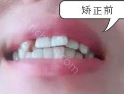 重庆市第三人民医院口腔科杨高峰隐形牙齿矫正真实案例分享