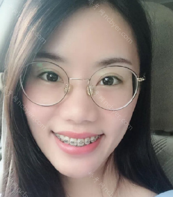 厦门世纪优典口腔门诊部陈经纬牙齿矫正案例
