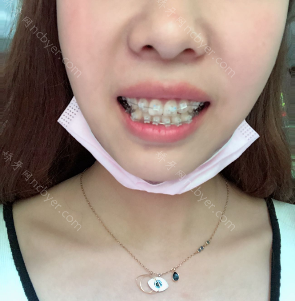 厦门思迈尔口腔徐平牙齿矫正案例展示