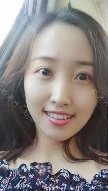厦门铂菲特口腔门诊部李世双牙齿矫正案例展示！