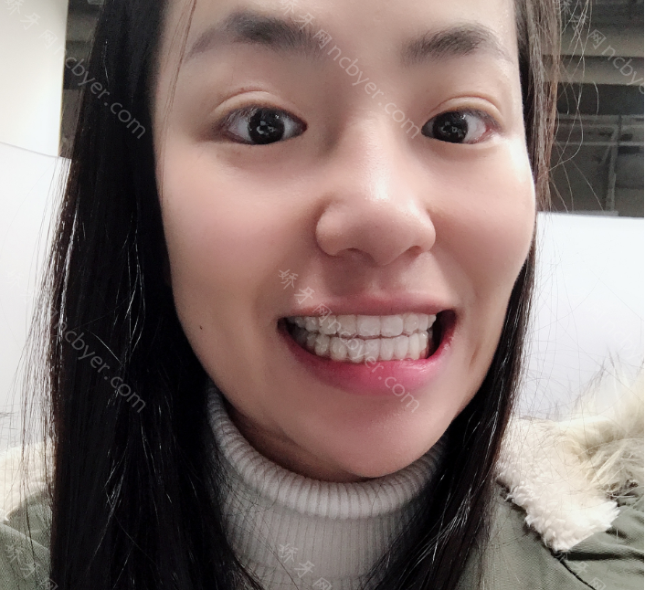 厦门康德佳口腔巫强平牙齿矫正案例展示！