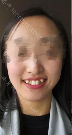 厦门登特口腔袁炜灵牙齿矫正案例展示！