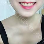 武汉康承贝健口腔医院李碧艳牙齿矫正案例分享
