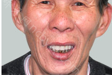 长沙优享国际口腔门诊部张玉林案例展示