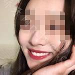 武汉固齐口腔医院陈腊梅医生牙齿美白案例分享