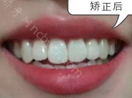 重庆市巴南区人民医院口腔科袁荣龅牙矫正真实案例分享