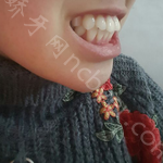 武汉达美口腔医院李苗案例分享