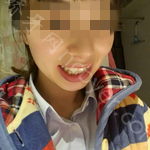 武汉达美口腔医院李苗案例分享