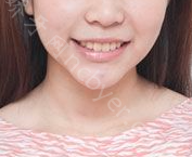 长沙科尔雅文智超龅牙矫正案例展示