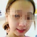 武汉达美口腔医院程浩牙齿贴面案例分享