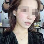 武汉冠美口腔医院李德龙医生牙齿美白案例分享