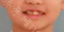 长沙美华口腔臧靖牙齿矫正案例