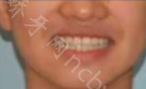 长沙美华口腔臧靖牙齿矫正案例