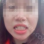 武汉市中心医院口腔科余小平牙齿矫正案例分享