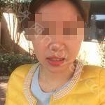 武汉市中心医院口腔科余小平牙齿矫正案例分享