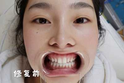 北京协和医院口腔科杜德顺做牙齿美白案例分享