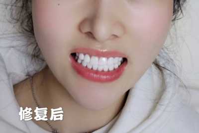北京协和医院口腔科杜德顺做牙齿美白案例分享