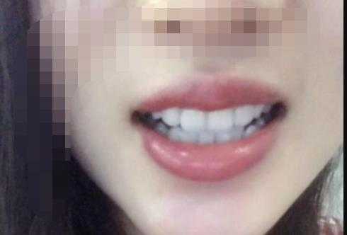 广州穗华牙科做烤瓷牙多少钱？做烤瓷牙后个人