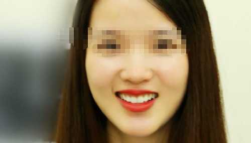 广州穗华牙科做烤瓷牙多少钱？做烤瓷牙后个人