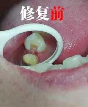 补牙多少钱一颗牙？内含价格表以及案例