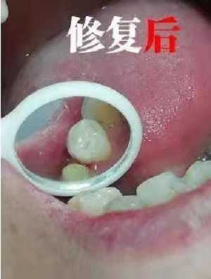 补牙多少钱一颗牙？内含价格表以及案例