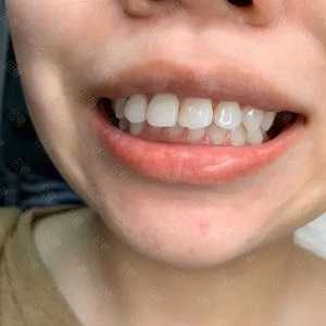 深覆合牙齿怎么矫正？附价格表以及案例
