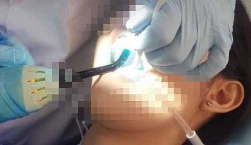 海涛口腔医院补牙多少钱？影响价格的因素有哪些？真人补牙体验反馈！
