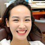 美维特全瓷牙多少钱一颗?哪些因素影响美维特全瓷牙的价格？真人术后体验反馈!