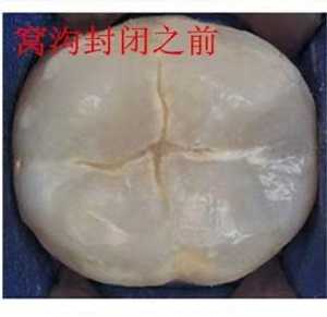 窝沟封闭美国3m多少钱？影响价格因素有哪些？内含优秀案例和价格表