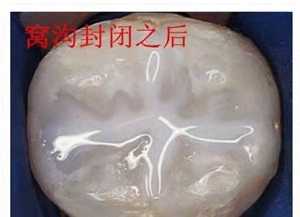 窝沟封闭美国3m多少钱？影响价格因素有哪些？内含优秀案例和价格表