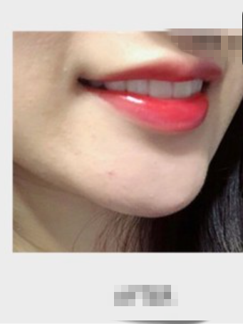 皓齿美白对怀孕有影响吗？皓齿美白一次要多少钱呢？