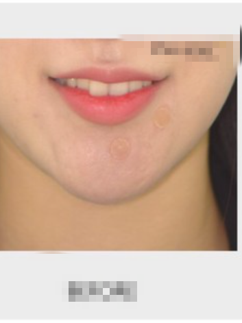 皓齿美白对怀孕有影响吗？皓齿美白一次要多少钱呢？