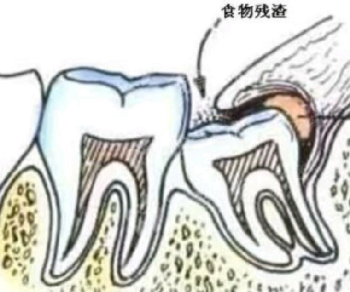 智齿拔了有什么影响？智齿的危害是什么？拔智齿亲身经历告诉你