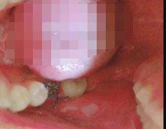 种植牙价钱一般要多少？真人种植牙使用前后效果对比！