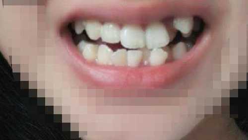 隐形牙套多少钱？隐形牙套人人适合吗？使用隐形牙套矫正前后效果对比！