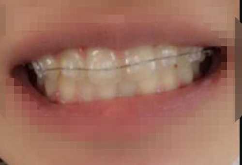 隐形牙套多少钱？隐形牙套人人适合吗？使用隐形牙套矫正前后效果对比！