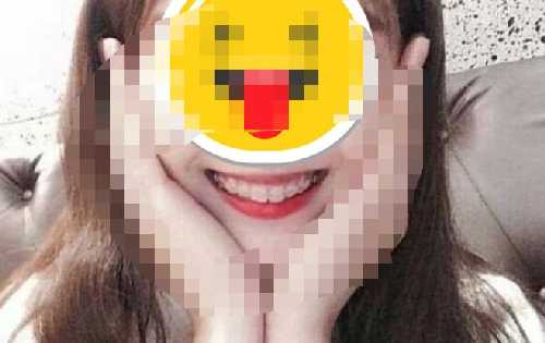 隐形牙套多少钱？隐形牙套人人适合吗？使用隐形牙套矫正前后效果对比！