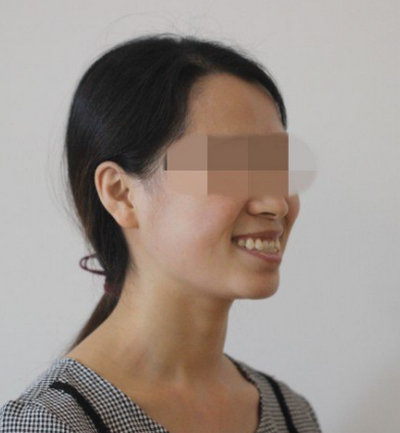 北京中诺口腔医院李鑫地包天矫正效果分享