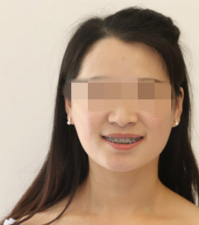 北京中诺口腔医院李鑫地包天矫正效果分享