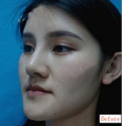 北京中诺口腔医院李鑫牙齿矫正效果分享