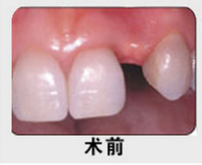 北京中诺口腔医院李鑫种植牙真实案例分享效果
