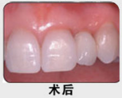 北京中诺口腔医院李鑫种植牙真实案例分享效果