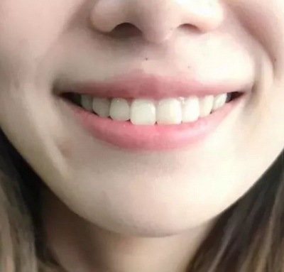 长沙市口腔医院李明做牙齿美白的真实案例分享！