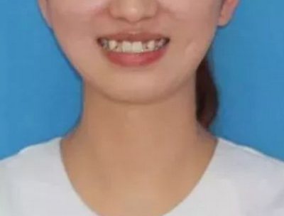 长沙口腔医院张敬阳牙齿矫正案例真实效果分享